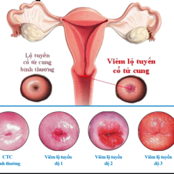 Chữa viêm lộ tuyến cổ tử cung Bắc Ninh – Giải pháp nhanh chóng, không lo tái phát