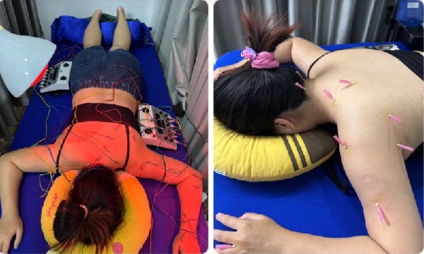 Châm cứu điện có đau không? So sánh với châm cứu truyền thống