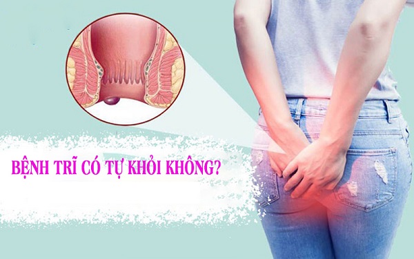 Bệnh trĩ có tự hết không? Cách xử lý an toàn, hiệu quả hiện nay